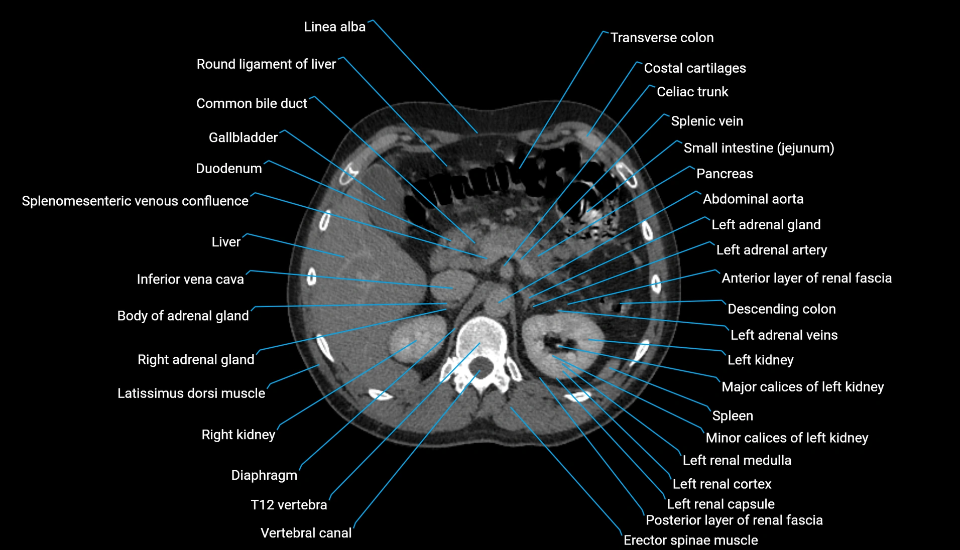 CT urogram axial cross sectional anatomy  labelled radiology image-00082.webp